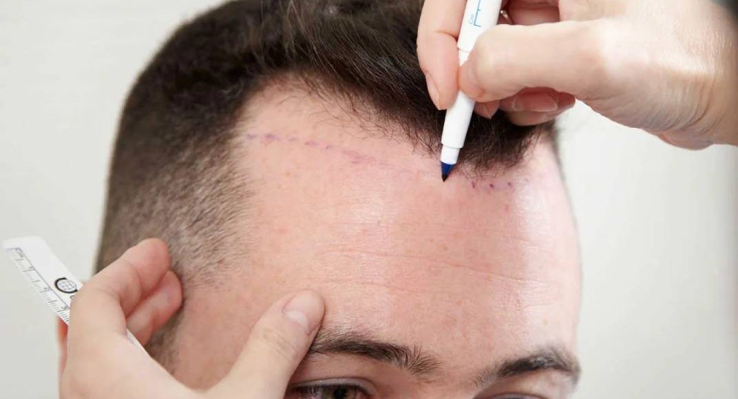 كم تكلفة زراعة الشعر في تركيا 2023